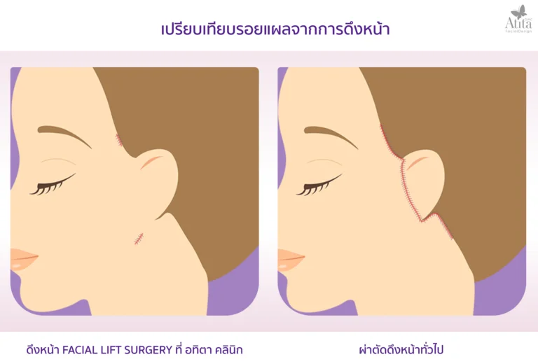 Atita Clinic คลินิกดึงหน้า Mini Face Lift แผลเล็ก ไม่มีรอยแผลผ่าตัดให้น่ากังวล - 2