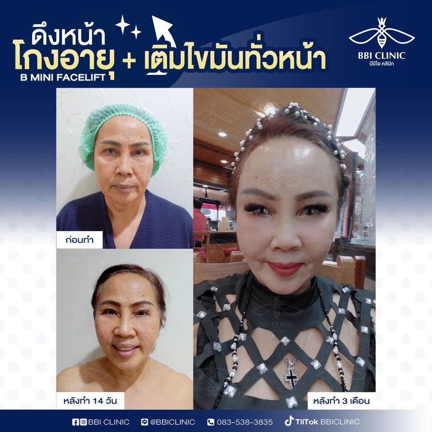 BBI Clinic บริการดึงหน้า Mini Face Lift เทคนิคการดึงหน้าส่งตรงจากประเทศเกาหลี - 2