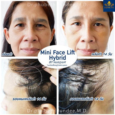 Elegance Clinic ศัลยกรรมดึงหน้า Mini Face Lift เทคนิคผสม ดึงทุกจุดของชั้นกล้ามเนื้อผิว - 2