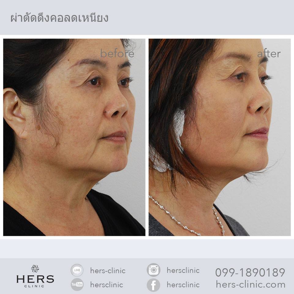 Hers Clinic บริการดึงหน้า Mini Face Lift ลดผิวหย่อนคล้อย ริ้วรอยผิวที่เคยเห็นชัดดูจางลง - 2