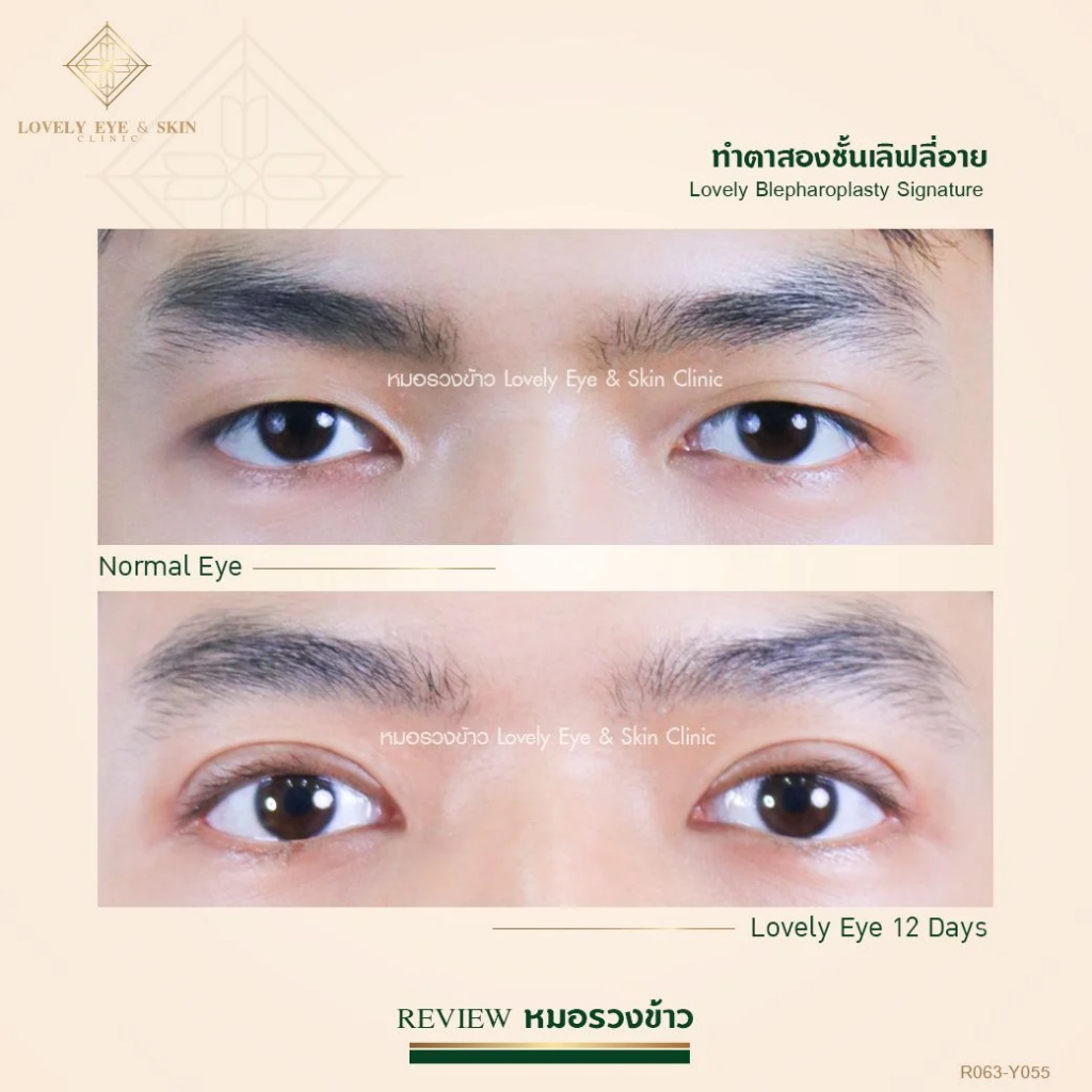 Lovely Eye & Skin Clinic ทำตาสองชั้นผู้ชาย เสริมเสน่ห์ให้ดวงตา มีมิติเห็นได้ชัดขึ้นกว่าเดิม - 2