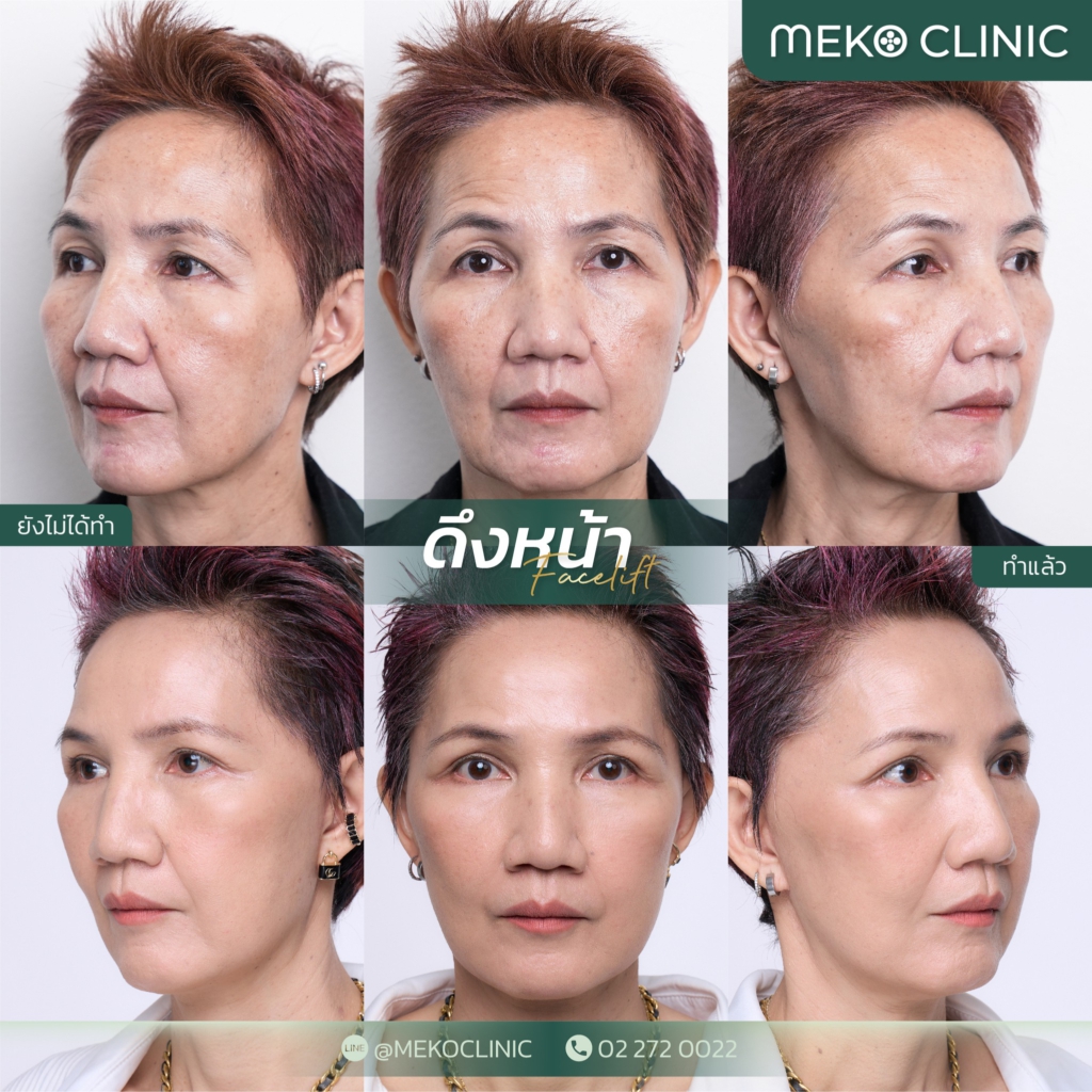 Meko Clinic ศัลยกรรมดึงหน้า Mini Face Lift ลดความกังวลของผิวหน้าที่มีริ้วรอยเด่นชัด - 2