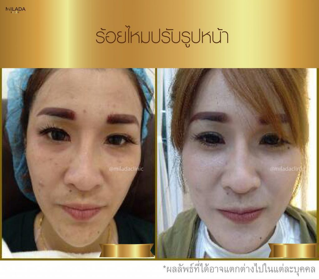 Milada clinic คลินิกร้อยไหม ขอนแก่น การันตีฝีมือแพทย์ผู้เชี่ยวชาญจัดพร้อมบริการ - 2