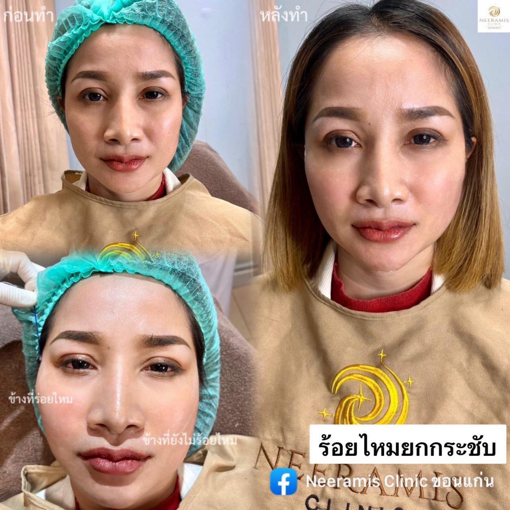 Neeramis Clinic ร้อยไหม ขอนแก่น โปรคุ้มค่ากระชับผิวหน้า ปรับหน้าเรียว ร้อยไหมคุณภาพดี - 2