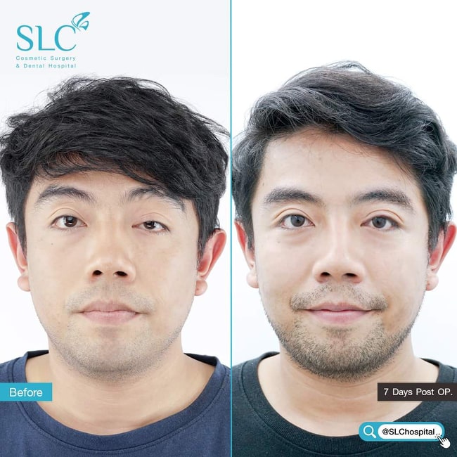 SLC Hospital บริการทำตาสองชั้นผู้ชาย ดวงตาดูสวยใส ไร้รอยแผลให้กังวล - 2