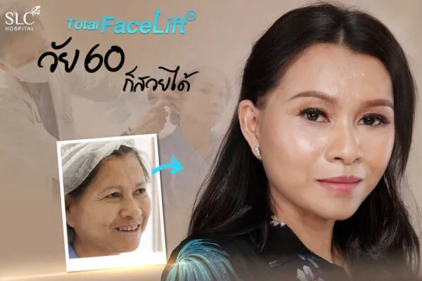 SLC Hospital ศัลยกรรมดึงหน้า Mini Face Lift สวยได้ ไม่มีพัง ตกแต่งผิวหน้าเทคนิคชั้นนำ - 1