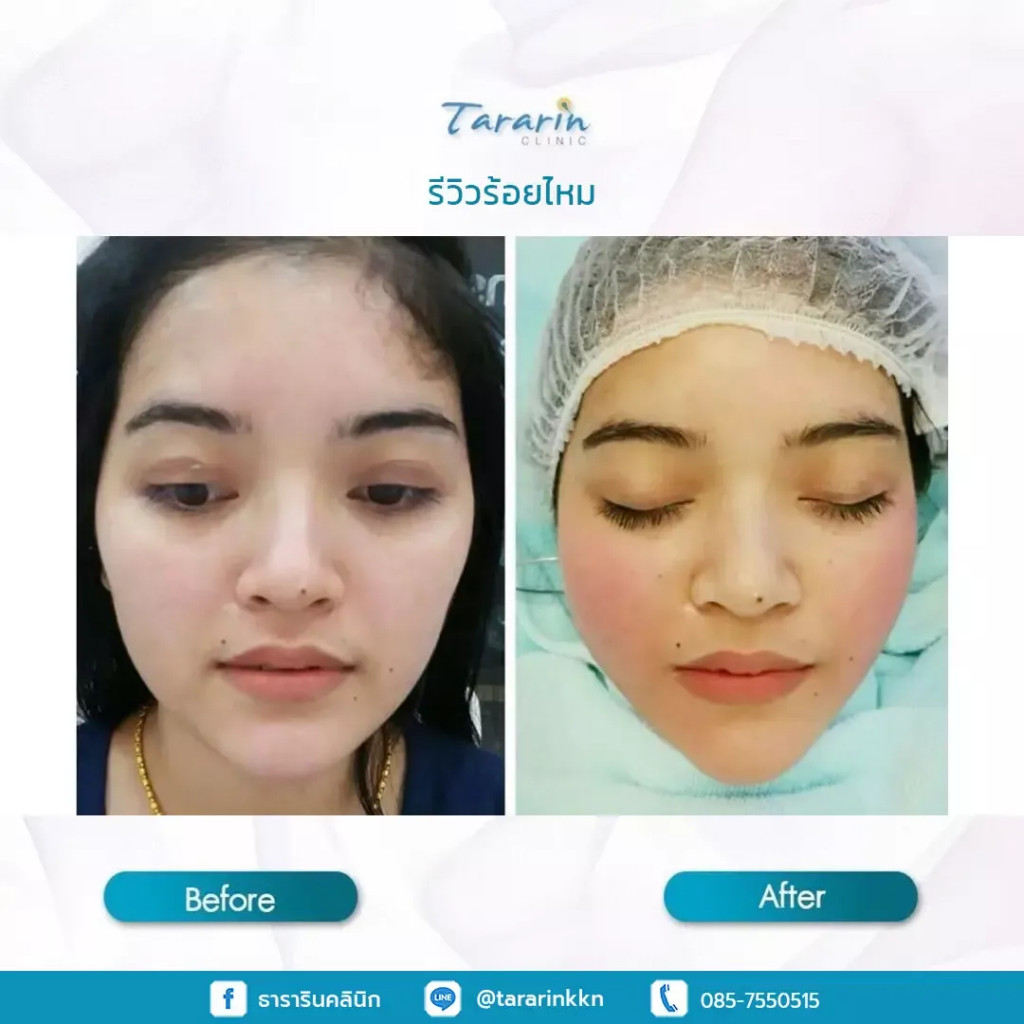 Tararin Clinic บริการร้อยไหม ขอนแก่น ฟื้นฟูเซลล์ผิว กระตุ้นคอลลาเจนใหม่ภายใต้ชั้นผิว - 2