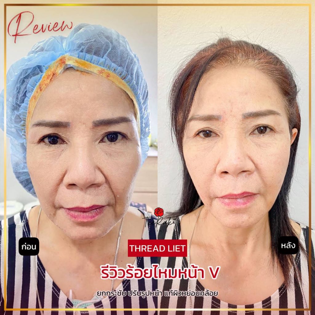 Teerak Clinic บริการร้อยไหม ขอนแก่น เทคนิคไหมละลาย ผิวหน้าตึง ผิวโดดเด่น ดูน่าสัมผัส - 2