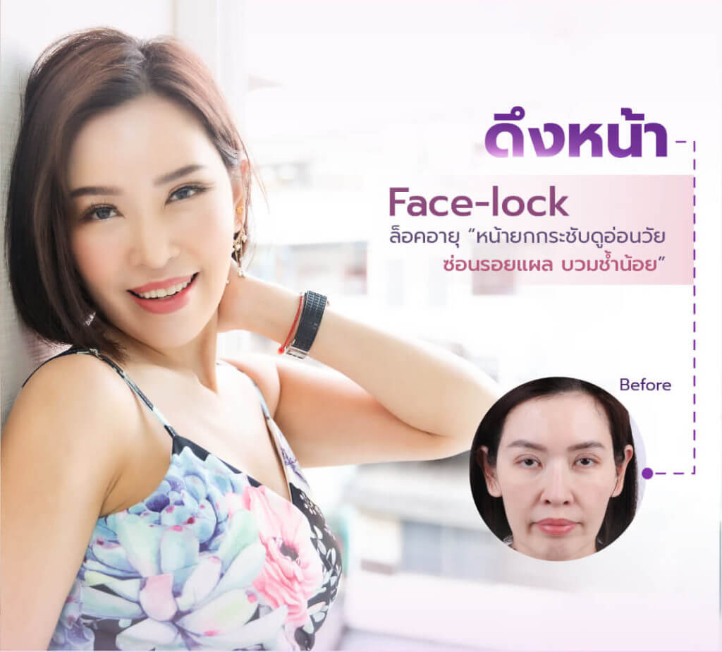 Teeraporn Clinic บริการดึงหน้า Mini Face Lift ล็อคอายุของผิวหน้าให้มีความมั่นใจอีกครั้ง - 2