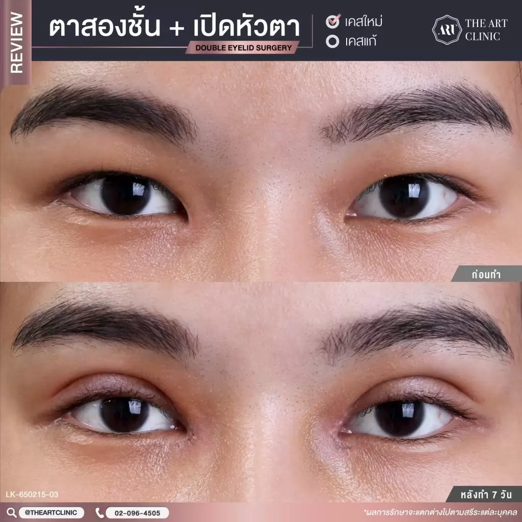 The Art Clinic คลินิกทำตาสองชั้นผู้ชาย เปิดนัยน์ตาเด่นชัด จุดประกายเสน่ห์ดวงตาอย่างชัดเจน - 2