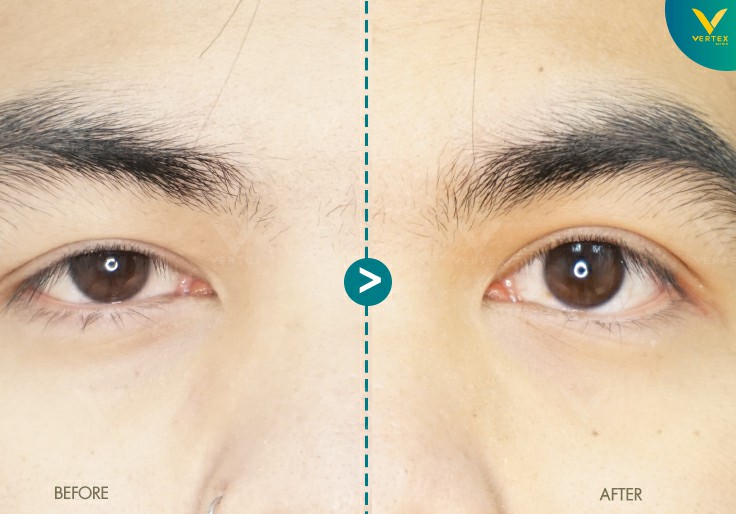 Vertex Clinic ทำตาสองชั้นผู้ชาย สร้างความมั่นใจในดวงตาที่สดใส ลดอาการตาอ่อนล้าที่เป็น - 2