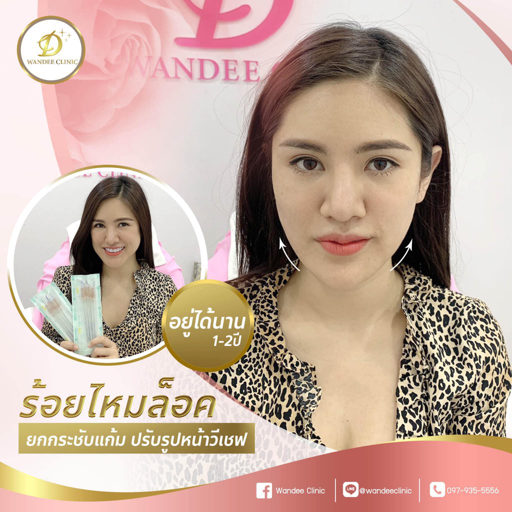Wandee Clinic ร้อยไหม ขอนแก่น เลือกเส้นไหมคุณภาพดี รีวิวพึงพอใจทุกคนที่เข้าทำ - 2