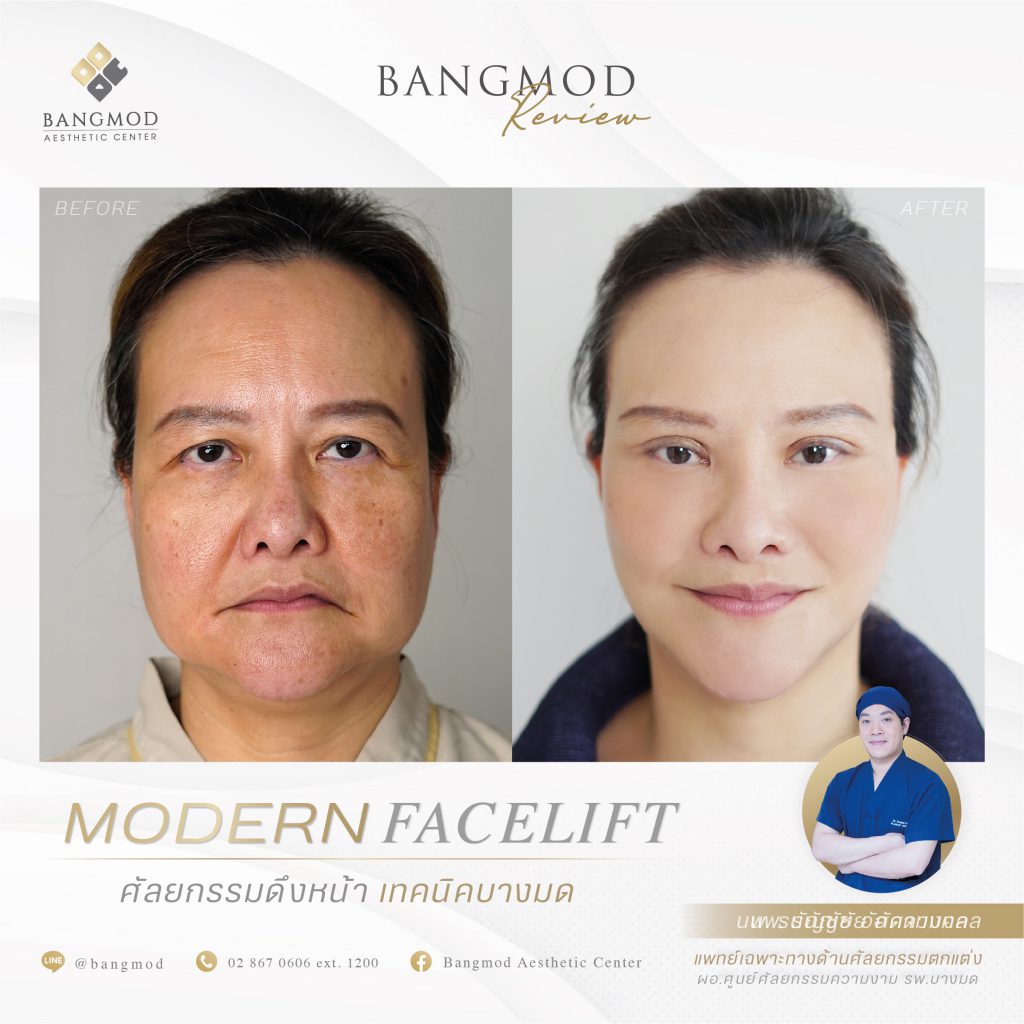 Bangmod Aesthetic Center ศูนย์ศัลยกรรมผ่าตัดยกหน้า เทคนิคปรับผิวหน้า ลดอายุผิวเด่นชัด - 2
