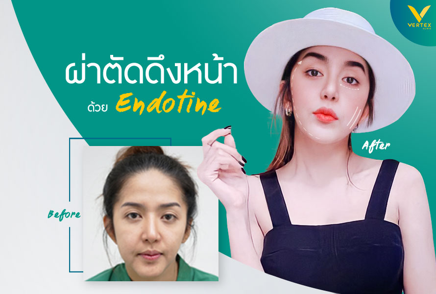 Vertex Clinic ผ่าตัดยกกระชับผิวหน้า สร้างความมั่นใจของผิวที่หายไปให้กลับมาอีกครั้ง - 2