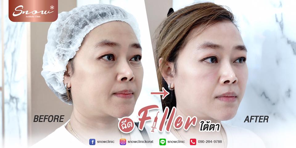 Snow Clinic ฉีดฟิลเลอร์ใต้ตา โคราช ปรับเสริมรูปหน้าได้รูปหน้าในแบบที่ต้องการ