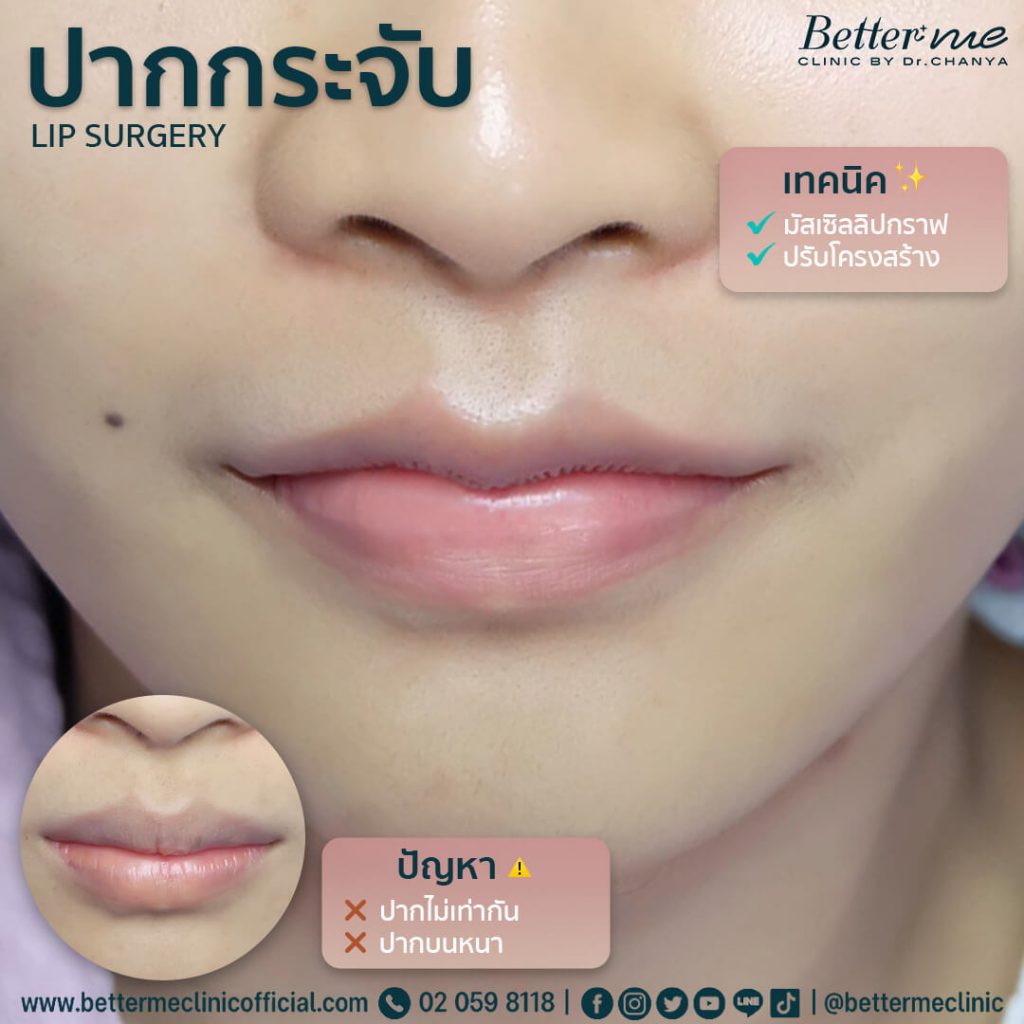 10 อันดับ ทำปากกระจับ ที่ไหนดี ดูสวยอ่อนนุ่ม ดูอวบอิ่มในทุกมุมมอง 3