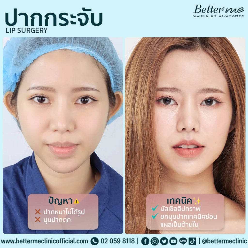 10 อันดับ ทำปากกระจับ ที่ไหนดี ดูสวยอ่อนนุ่ม ดูอวบอิ่มในทุกมุมมอง 1