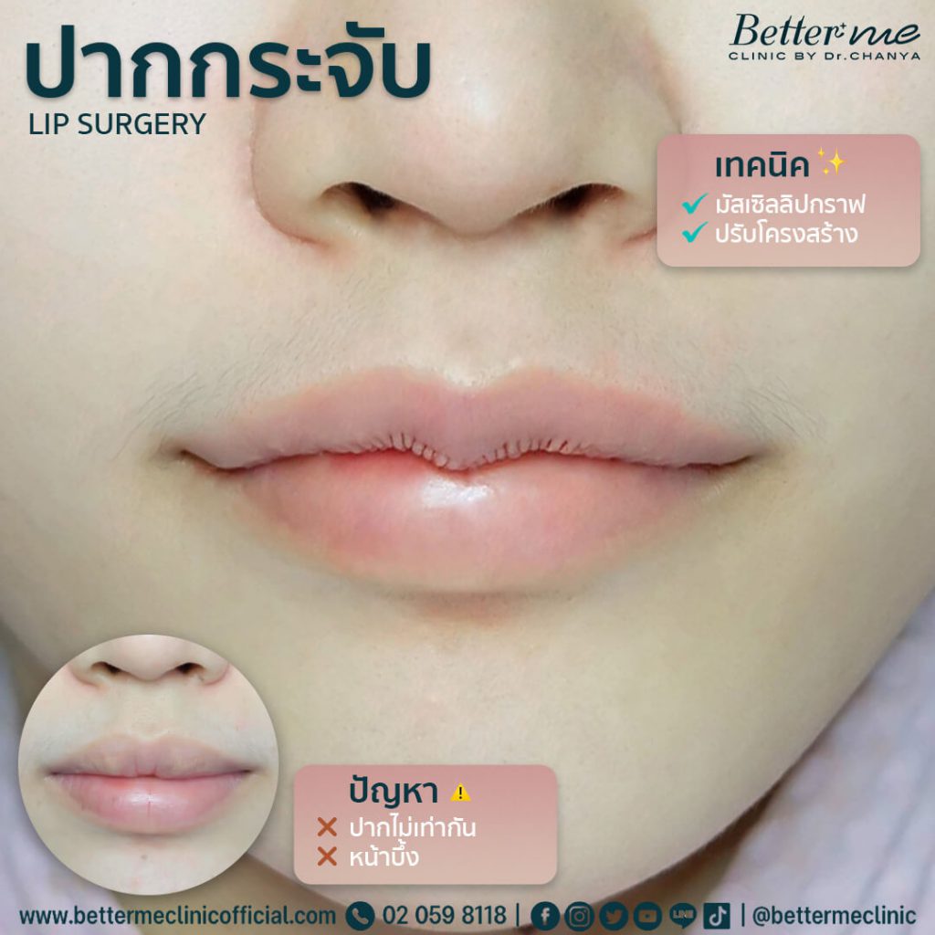 10 อันดับ ทำปากกระจับ ที่ไหนดี ดูสวยอ่อนนุ่ม ดูอวบอิ่มในทุกมุมมอง 4