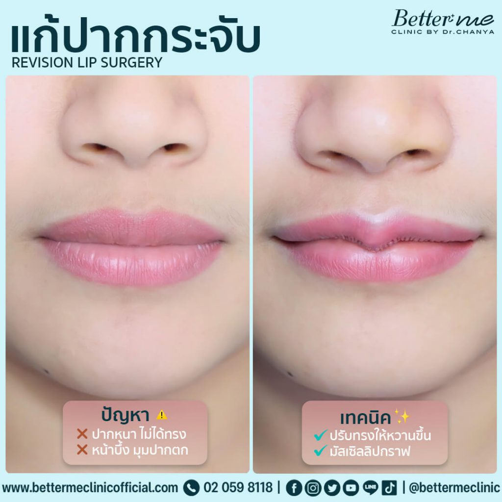10 อันดับ ทำปากกระจับ ที่ไหนดี ดูสวยอ่อนนุ่ม ดูอวบอิ่มในทุกมุมมอง 2