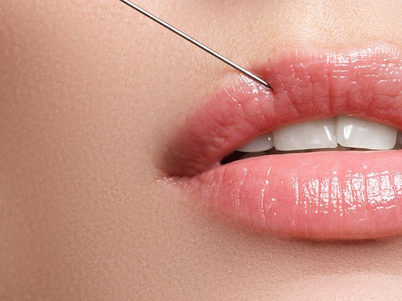 คลินิกฉีดฟิลเลอร์ปาก อุดรธานี - 2