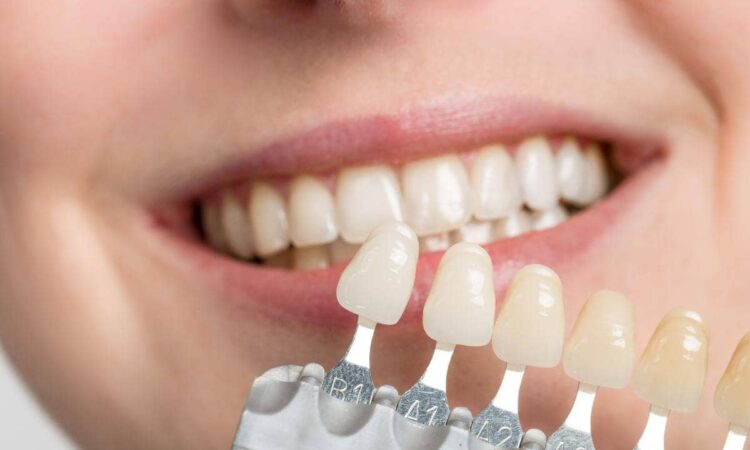 10 อันดับ วีเนียร์ กรุงเทพ ที่ไหนดี เสริมความมั่นใจให้รอยยิ้มดูโดดเด่น สดใสได้อย่างไม่ต้องกังวล 1 วีเนียร์ กรุงเทพ ที่ไหนดี - 1