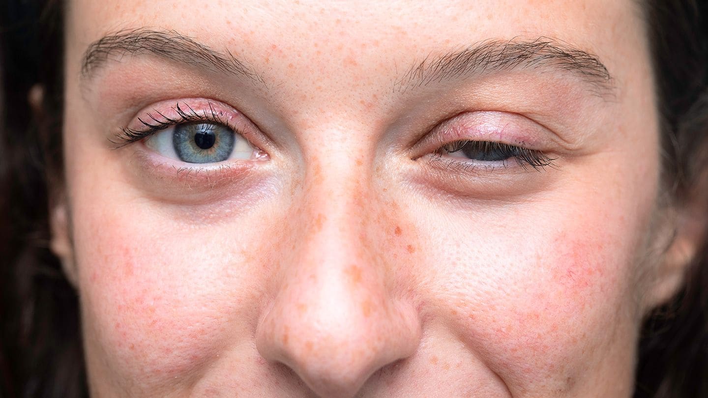 10 อันดับ คลินิกแก้กล้ามเนื้อตาอ่อนแรง ที่ไหนดี ลดอาการตาง่วง ตาปรือ รักษาหายได้ 2 คลินิกแก้กล้ามเนื้อตาอ่อนแรง ที่ไหนดี - 1