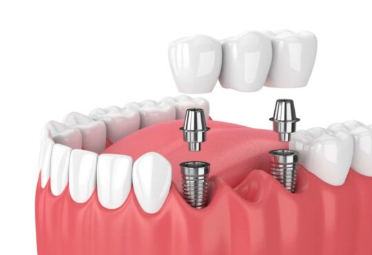 Where is a good dental implant clinic