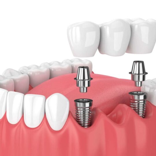 Where is a good dental implant clinic