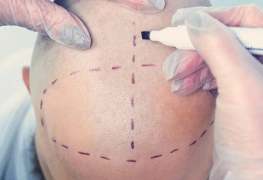 Where is a good hair transplant clinic in Nakhon Sawan