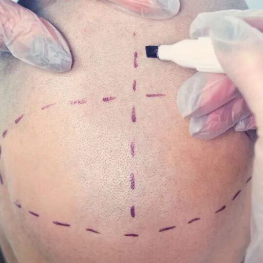 Where is a good hair transplant clinic in Nakhon Sawan