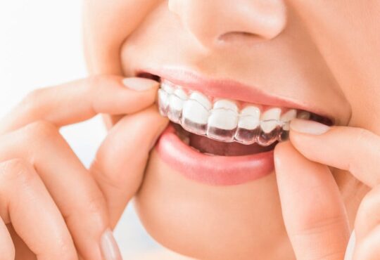 Where is a good place to get Invisalign clear braces