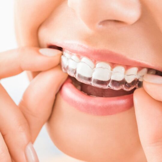 Where is a good place to get Invisalign clear braces