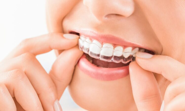 10 อันดับ จัดฟันใส Invisalign ที่ไหนดี ครอบฟันสะอาด ฟันเรียงสวยอย่างเป็นธรรมชาติ 1 Where is a good place to get Invisalign clear braces