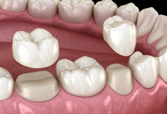 Where is a good place to get dental crowns