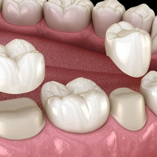 Where is a good place to get dental crowns