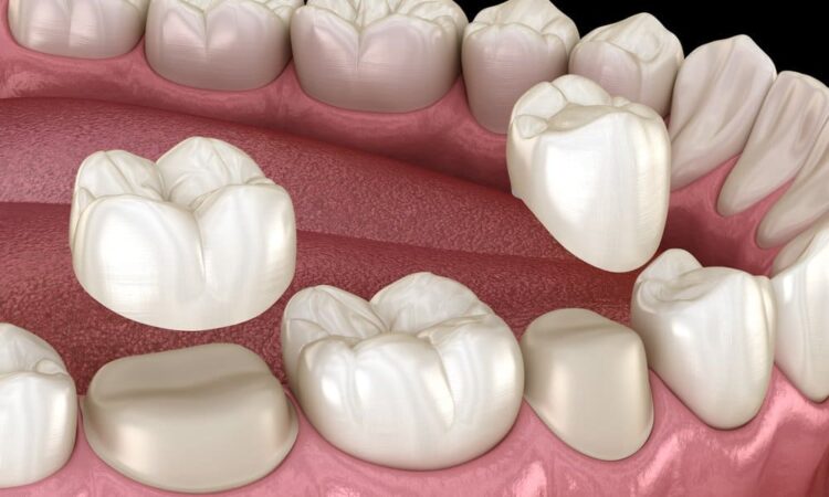 Where is a good place to get dental crowns
