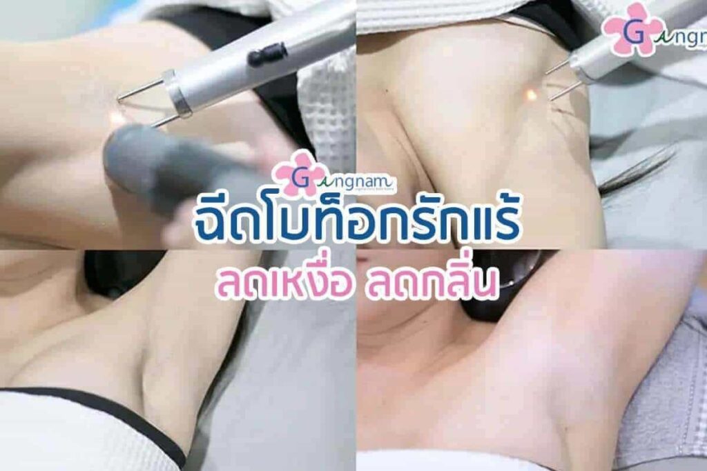 Gangnam Clinic คลินิกฉีดโบท็อกรักแร้ ขจัดปัญหาของผู้มีเหงื่อเยอะใต้วงแขนให้ออกมาน้อยลง