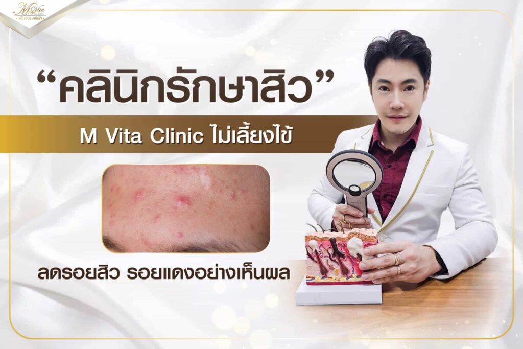 M Vita Clinic คอร์สหน้าใส ราคาไม่แพง เห็นผลเร็ว ปลอดภัย ลดรอยแดงจากสิวให้จางหายน้อยลง