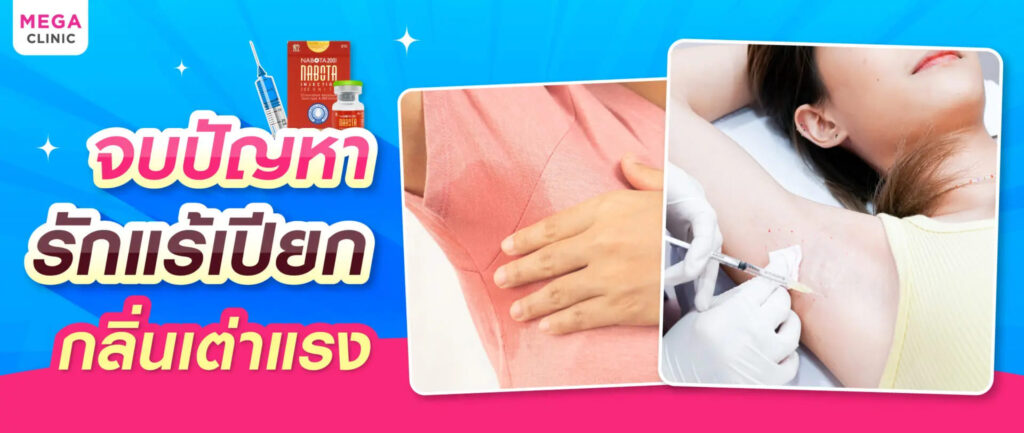 Mega Clinic คลินิกฉีดโบท็อกรักแร้ คุ้มค่าทุกผลลัพธ์หลังการฉีด ลดกลิ่นแรง ลดเหงื่อสะสม
